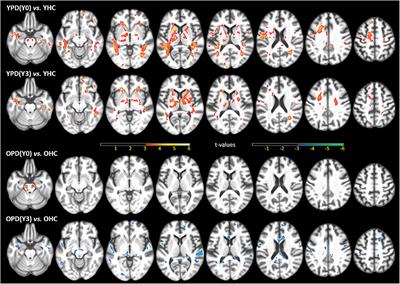 Diffusion Tensor Imaging in Parkinson's Disease and Parkinsonian Syndrome: A Systematic Review